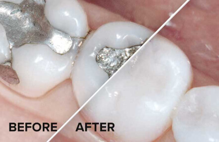 Mercury Free fillings before and After